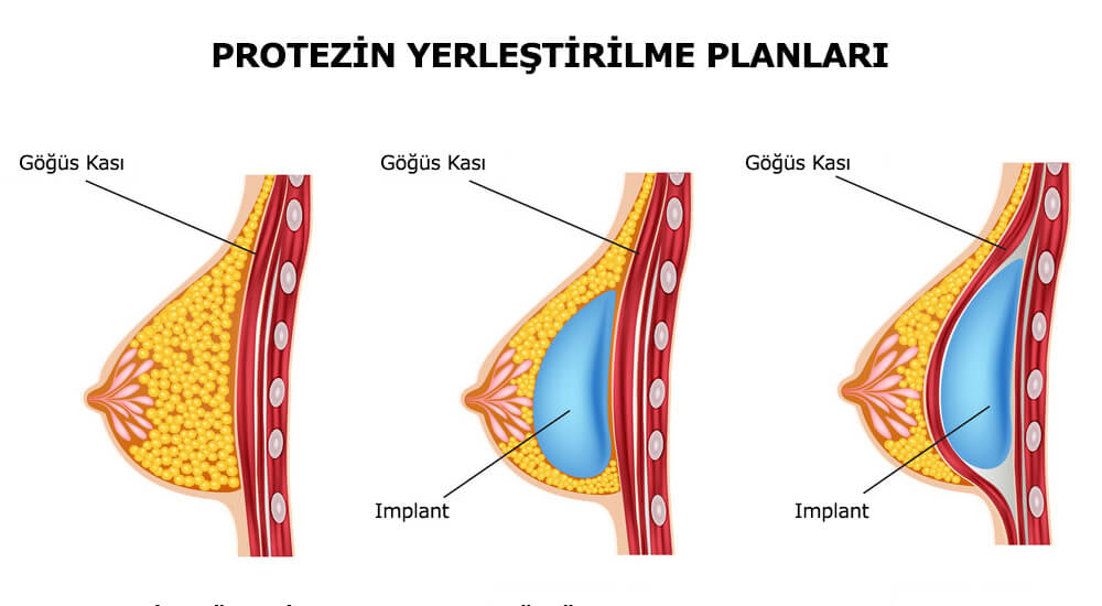 Meme büyütme ameliyatı nedir?